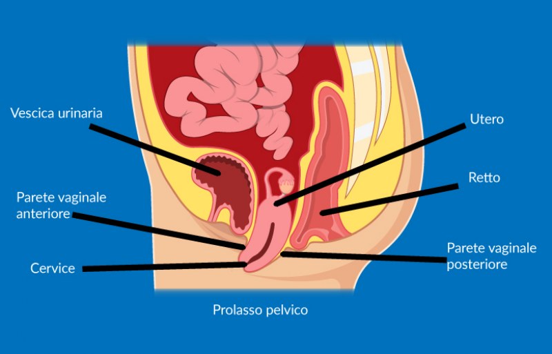 Prolasso-pelvico-cause-sintomi-e-rimedi_800x513